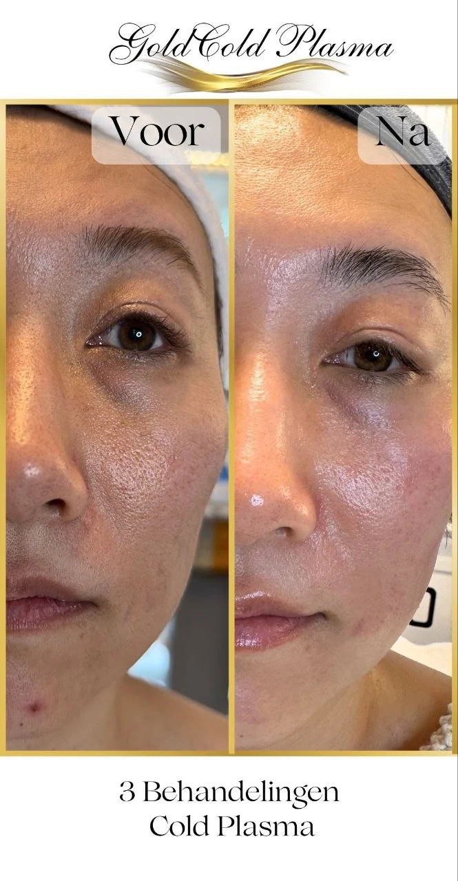 Before and after result of a Cold Plasma treatment at RA Beauty 15