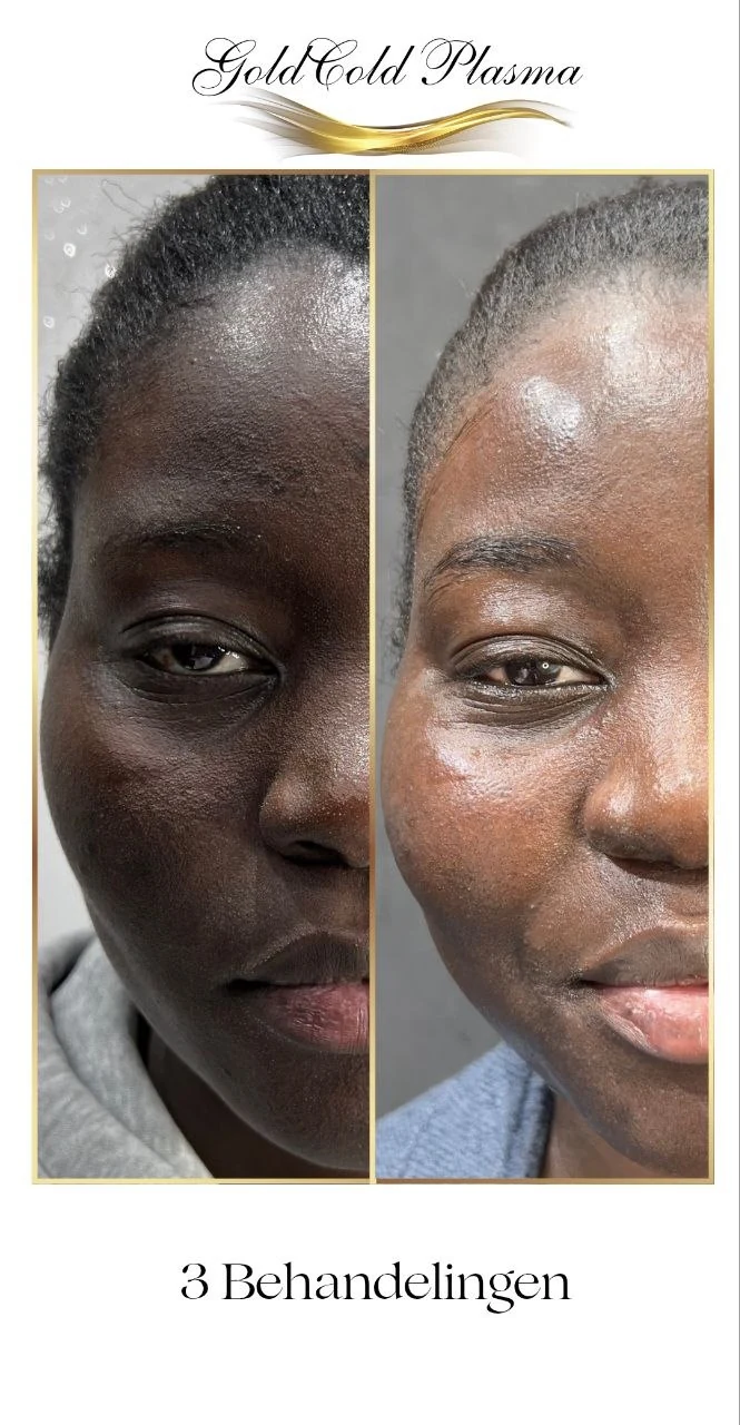 Before and after result of a Cold Plasma treatment at RA Beauty 1