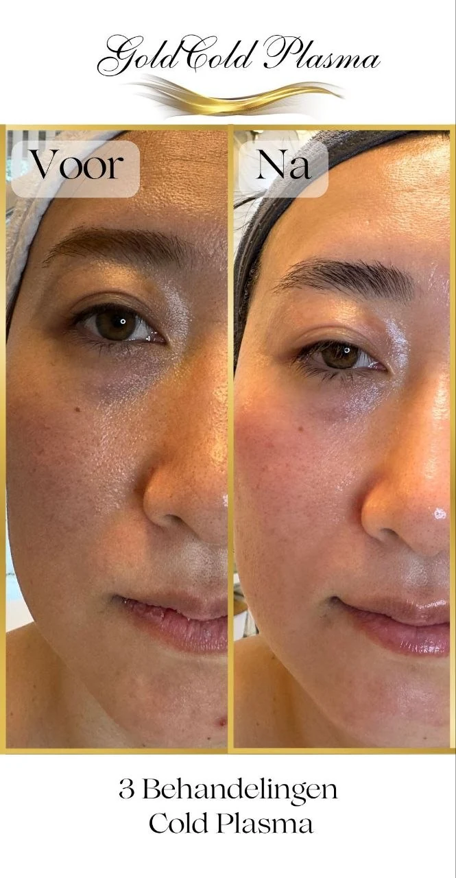 Before and after result of a Cold Plasma treatment at RA Beauty 16