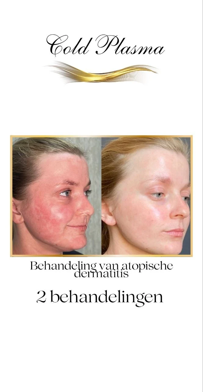 Before and after result of a Cold Plasma treatment at RA Beauty 3
