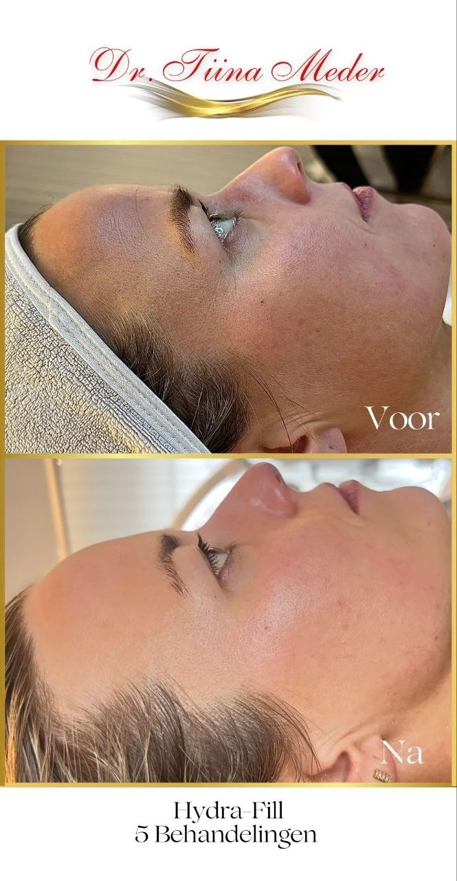 Voor en na resultaat Dr. Meder behandeling bij RA Beauty 2