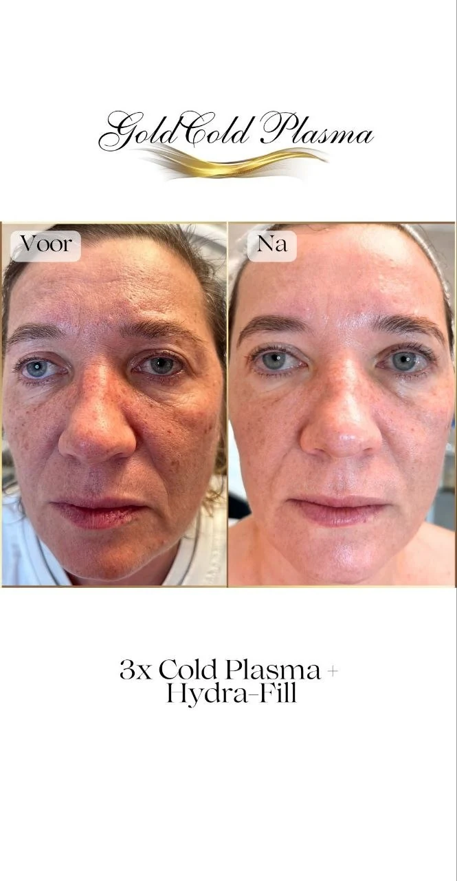 Before and after result of a Cold Plasma treatment at RA Beauty 10