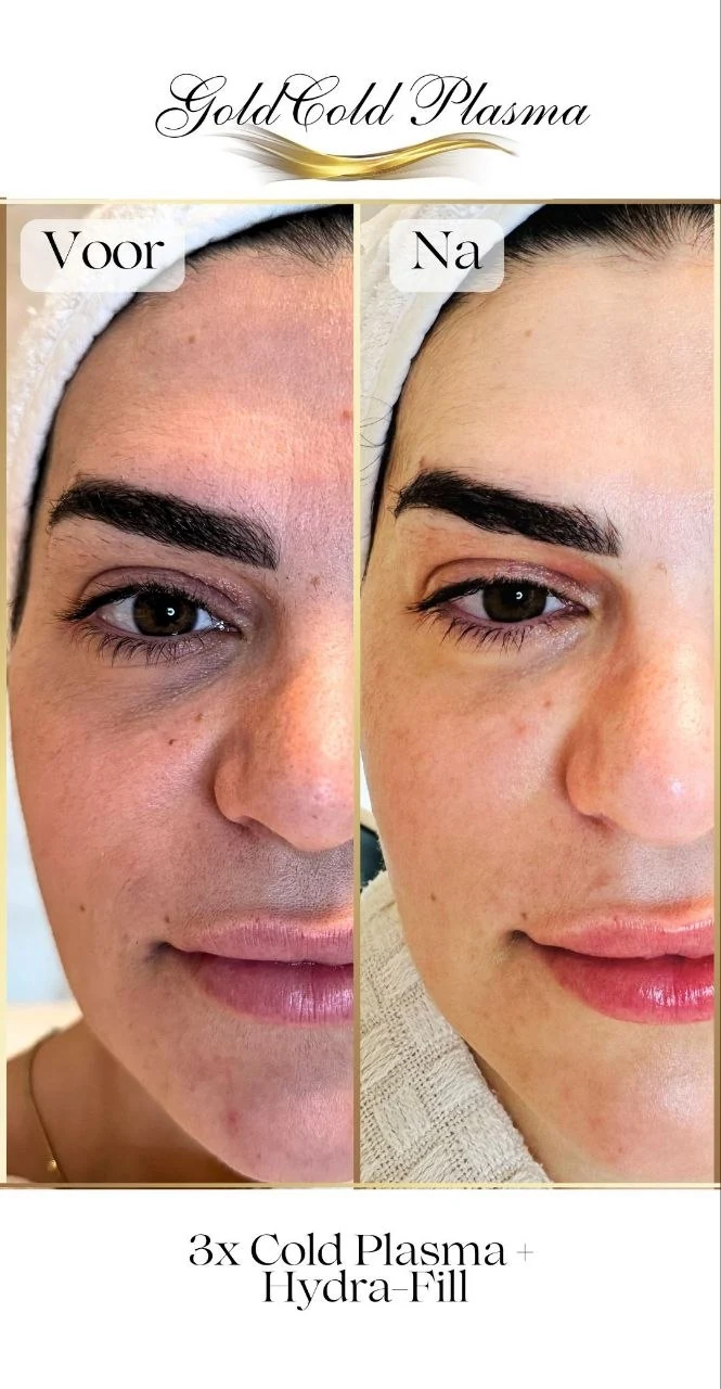 Before and after result of a Cold Plasma treatment at RA Beauty 5