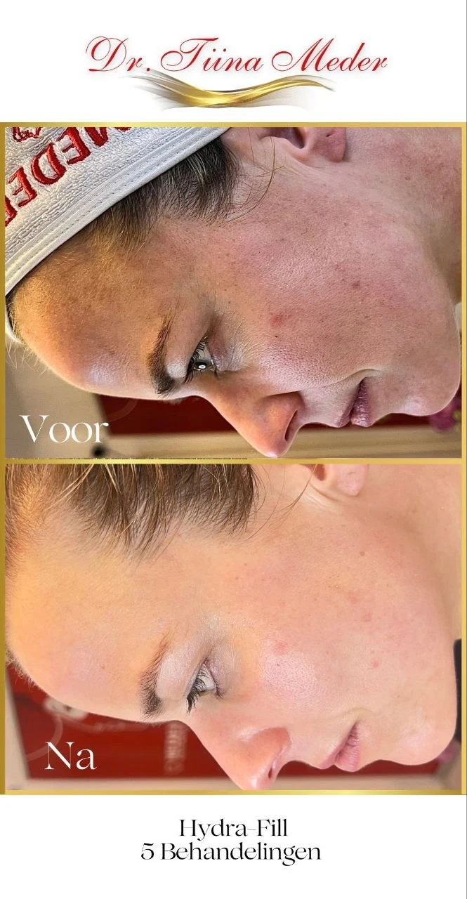 Voor en na resultaat Dr. Meder behandeling bij RA Beauty 3