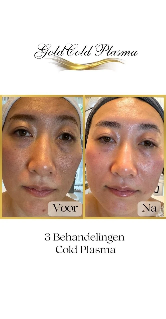 Before and after result of a Cold Plasma treatment at RA Beauty 13