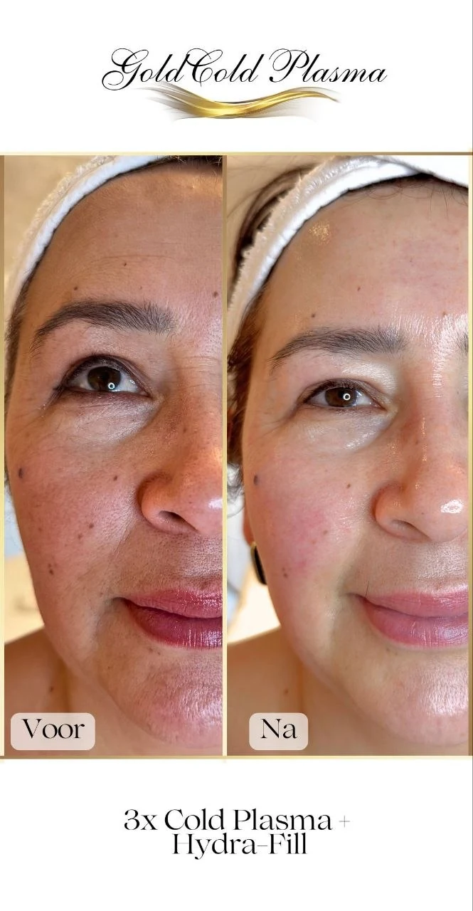 Before and after result of a Cold Plasma treatment at RA Beauty 7