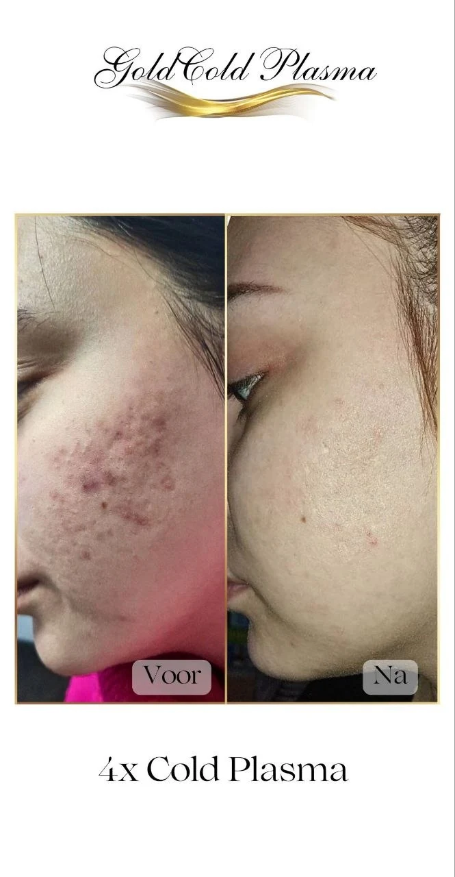 Before and after result of a Cold Plasma treatment at RA Beauty 11