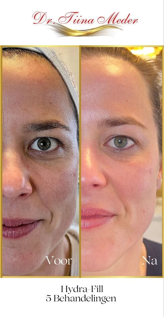 Voor en na resultaat Dr. Meder behandeling bij RA Beauty 1