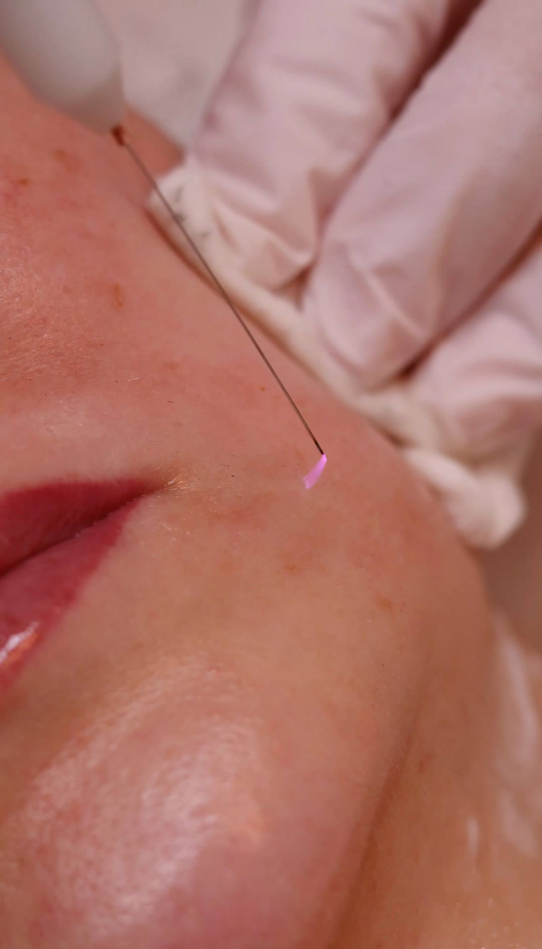 Cold Plasma vonk op de huid tijdens behandeling bij RA Beauty Antwerpen