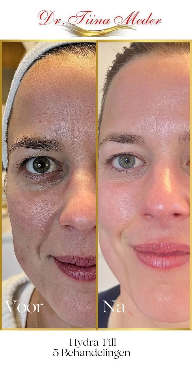 Voor en na resultaat Dr. Meder behandeling bij RA Beauty 4
