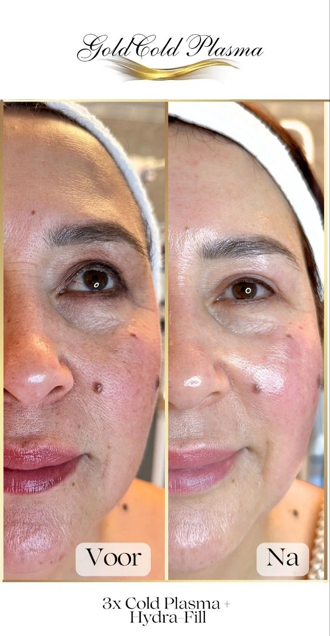 Before and after result of a Cold Plasma treatment at RA Beauty 6