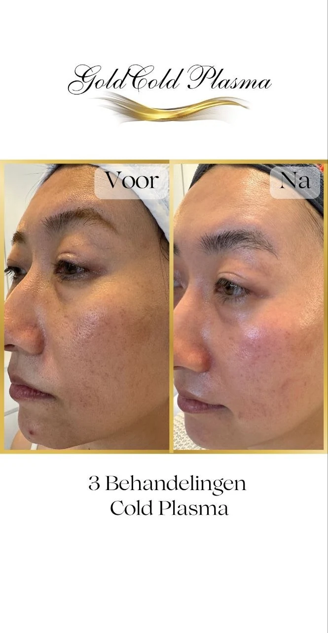 Before and after result of a Cold Plasma treatment at RA Beauty 14