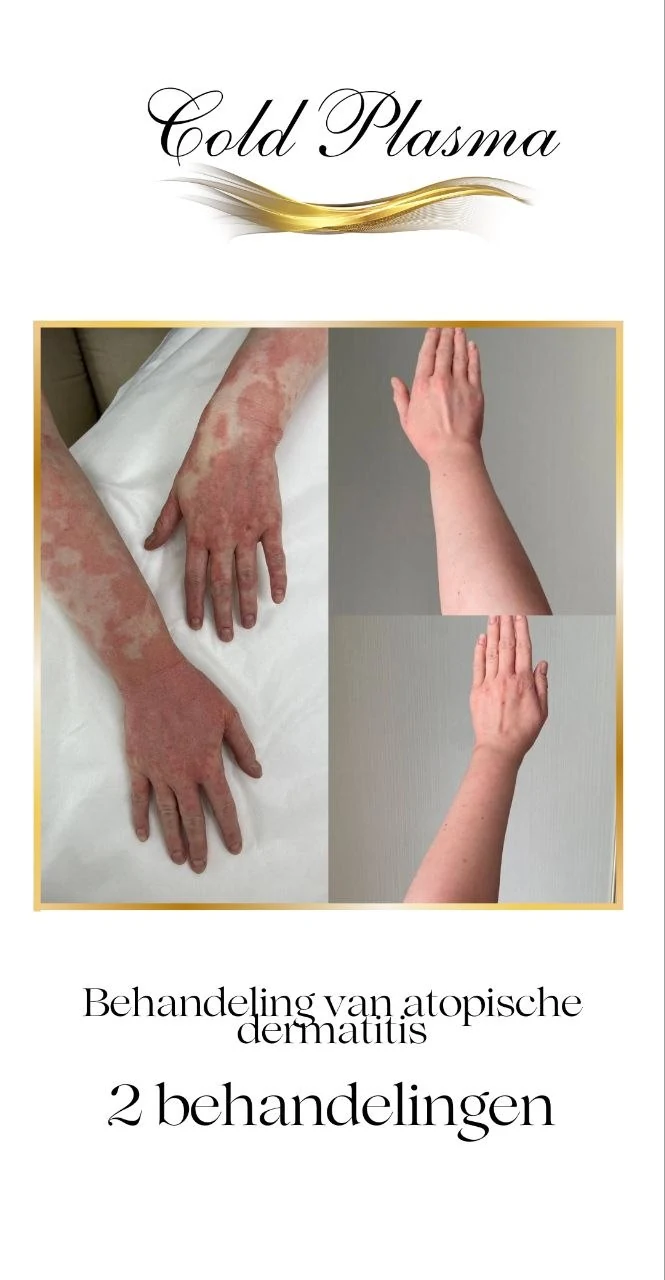 Before and after result of a Cold Plasma treatment at RA Beauty 2