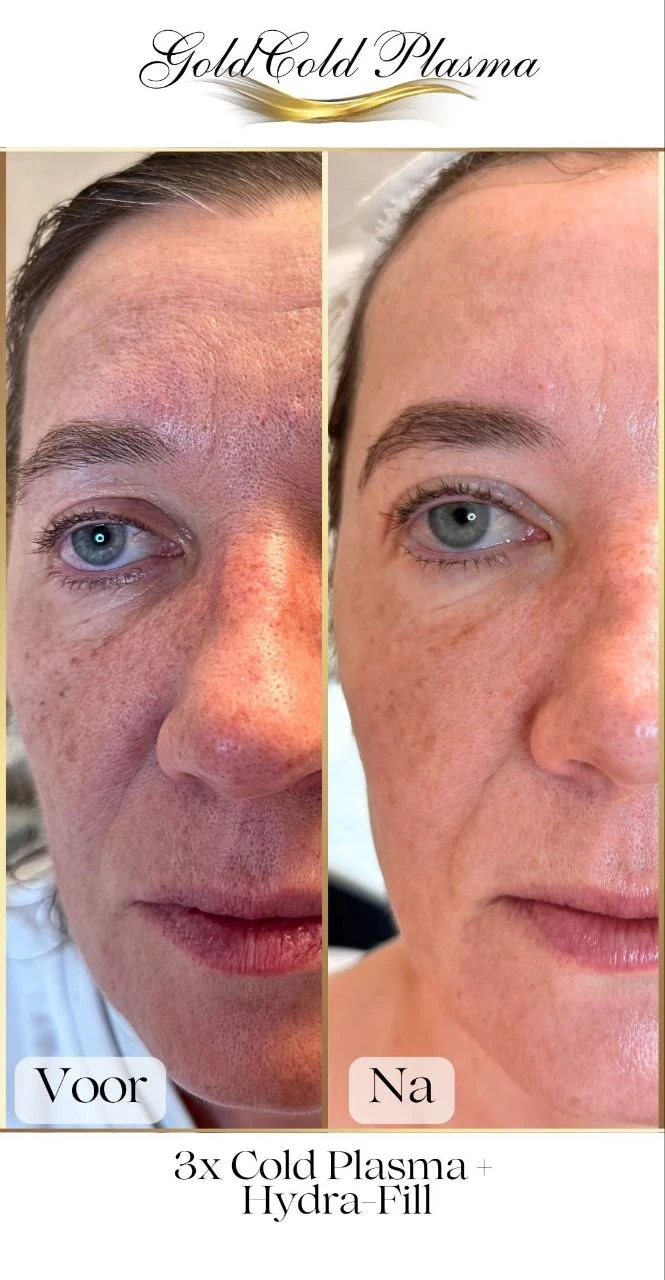 Before and after result of a Cold Plasma treatment at RA Beauty 9