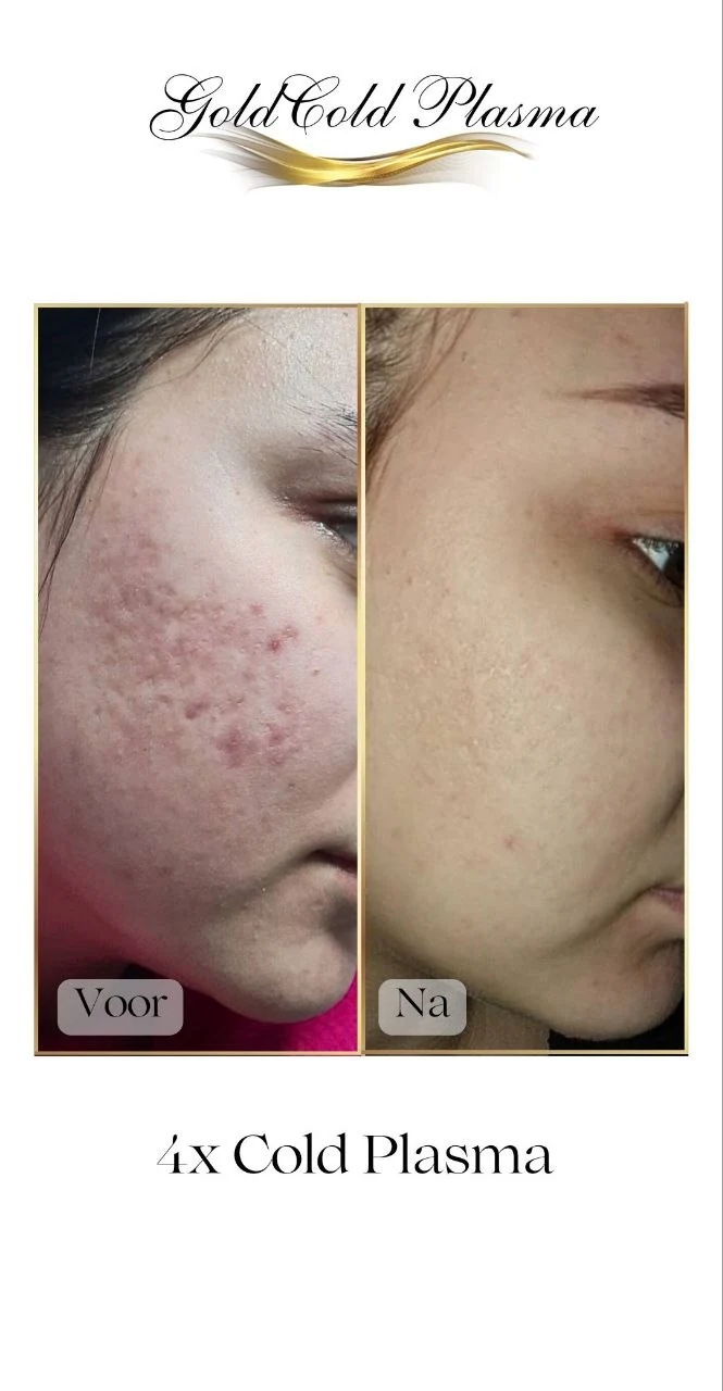 Before and after result of a Cold Plasma treatment at RA Beauty 12