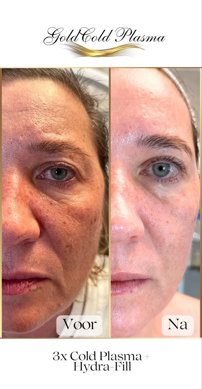 Before and after result of a Cold Plasma treatment at RA Beauty 8