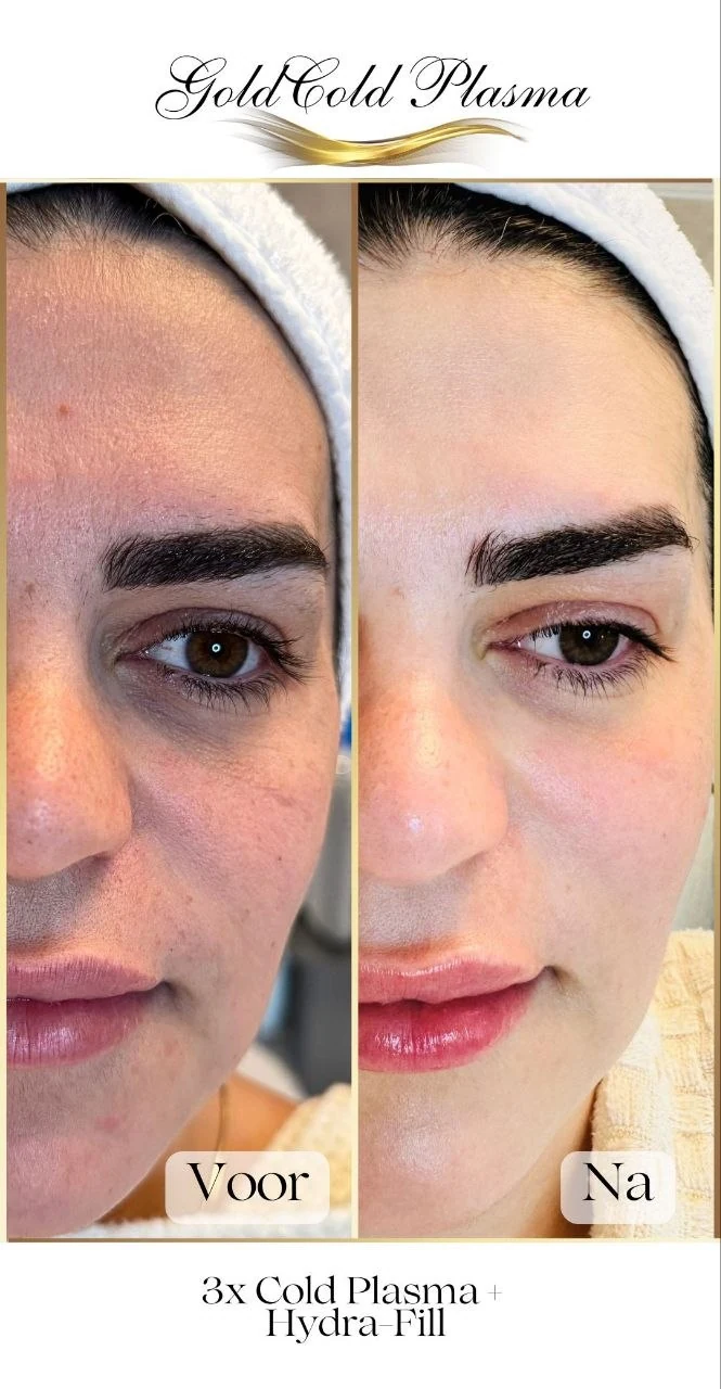 Before and after result of a Cold Plasma treatment at RA Beauty 4